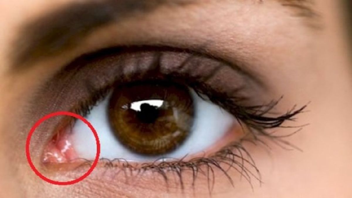 Qu’est-ce que c’est que ce petit coin rose à l’angle interne de votre œil ?