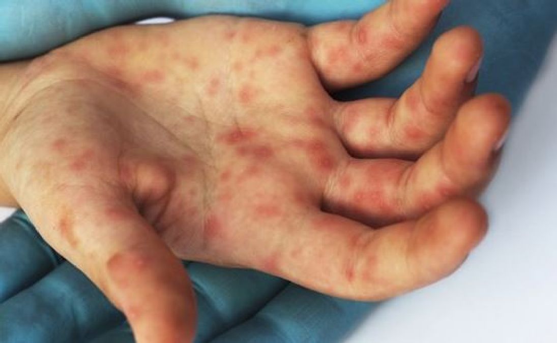 L’épidémie de rougeole entraine la mort d’une femme de 32 ans