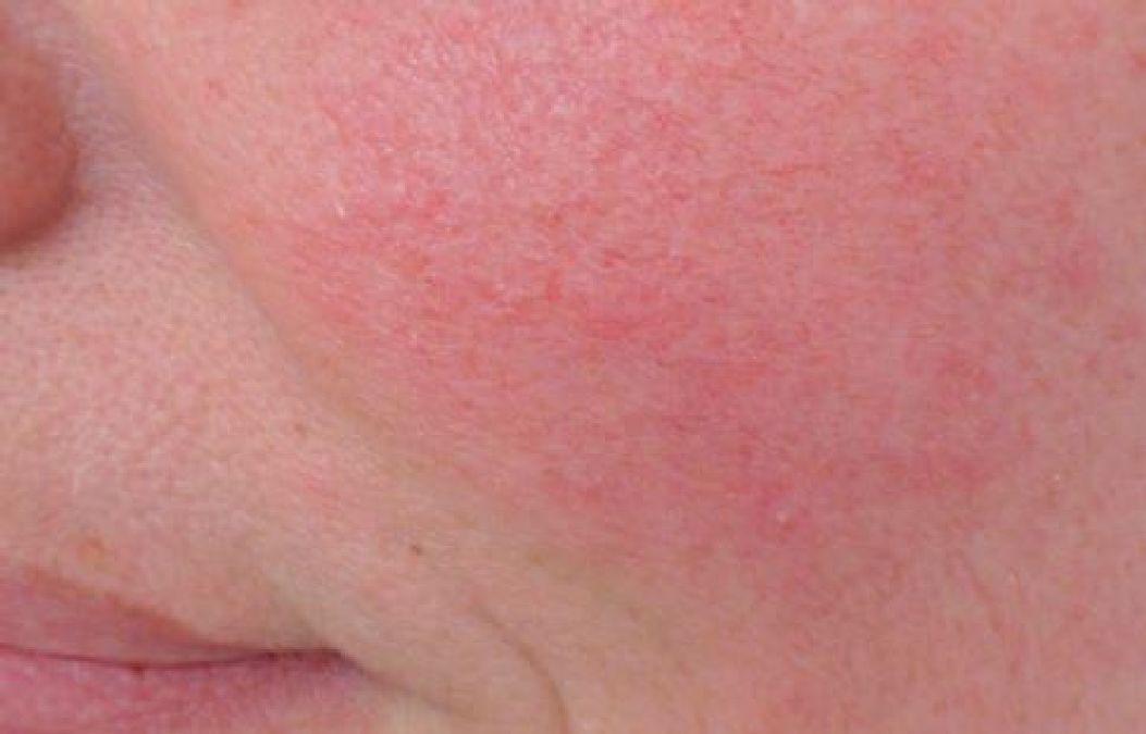 L’apparition de taches rouges sur votre peau n’est pas accidentelle et voici ce qu’elle signifie