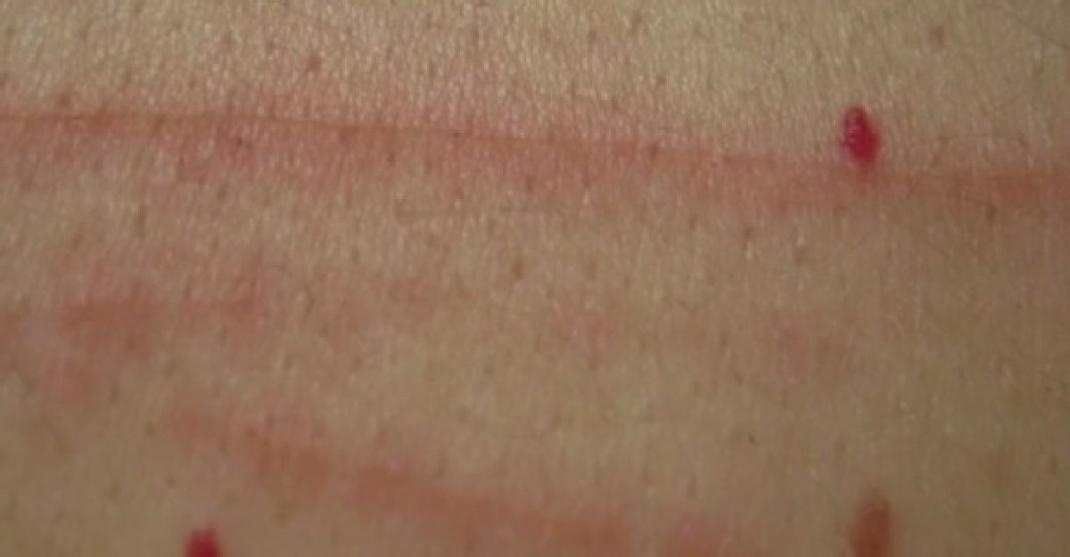 Faut-il s’inquiéter de ces tâches rouges qui apparaissent sur votre peau ?