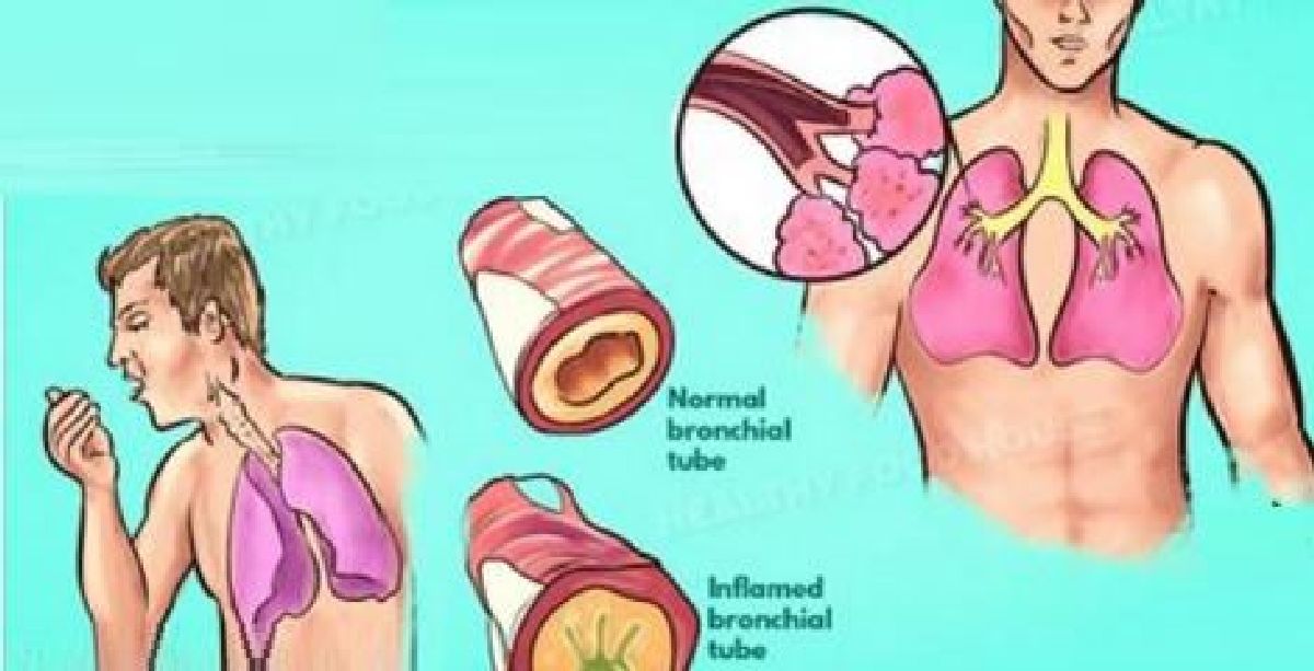 Comment se débarrasser du phlegme et du mucus de la poitrine et de la gorge
