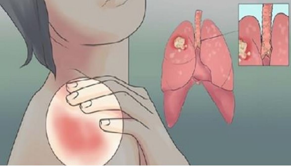 Des symptômes du cancer des poumons que les femmes doivent connaitre