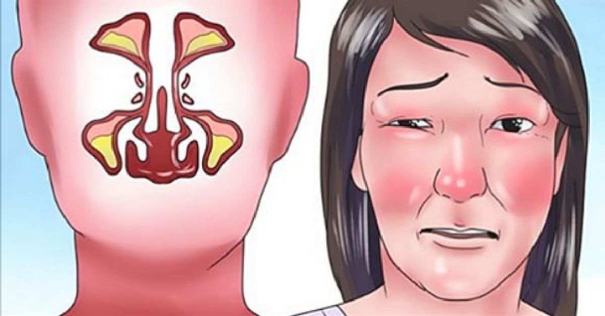 Remèdes maison contre la sinusite et comment soulager la douleur en 20 secondes