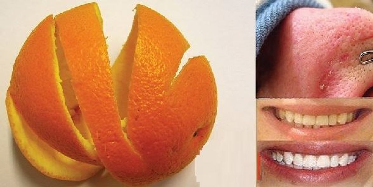 Ne jetez jamais les pelures d’orange! 3 recettes pour perdre du poids, blanchir vos dents et enlever les points noirs!