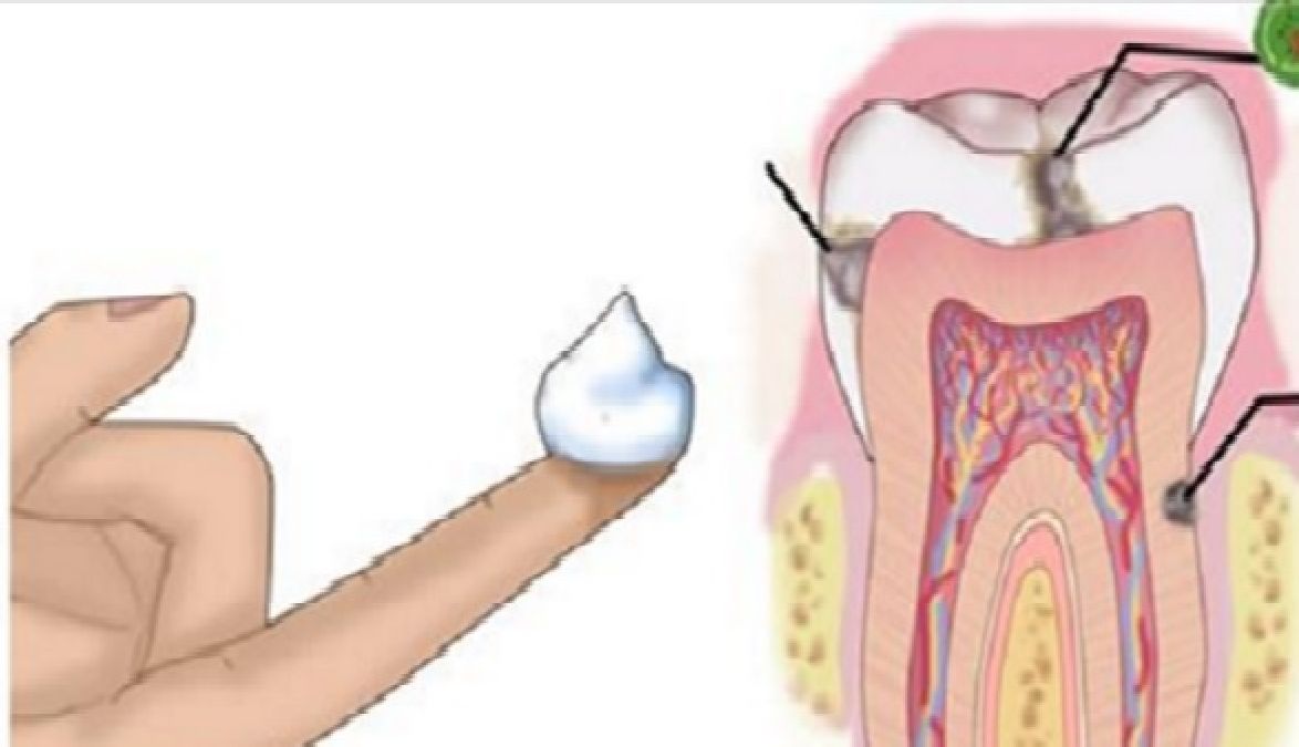 Aucun dentiste ne va vous révéler ceci : comment combattre les cavités à la maison