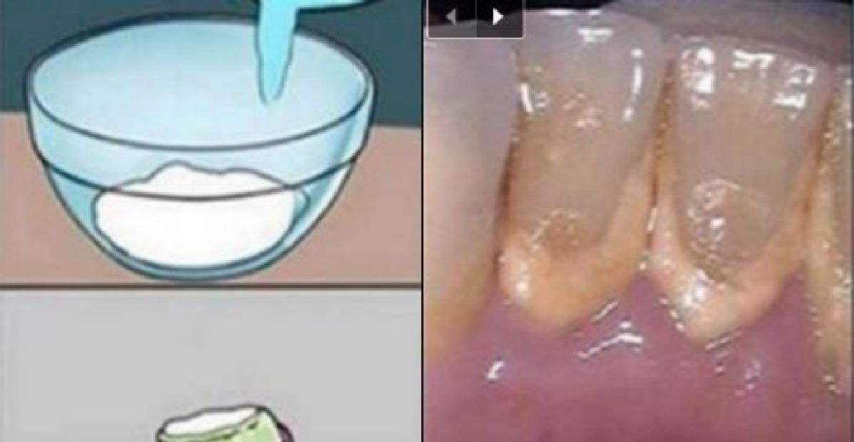 Ce rince-bouche élimine la plaque dentaire en 2 minutes