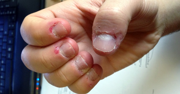 Si vous rongez la peau autour de vos ongles, vous devez immédiatement arrêter !  Découvre pourquoi