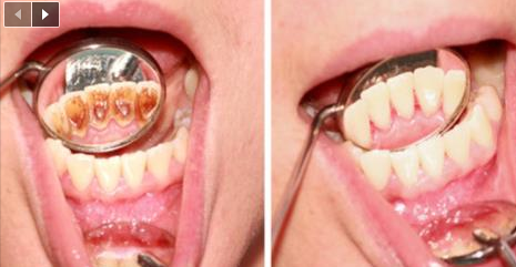Astuce  pour prévenir l’accumulation du tartre sur les dents