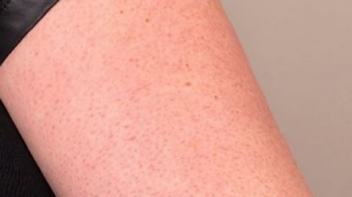Les petits boutons rouges sur vos bras et vos cuisses peuvent être causés par cette condition