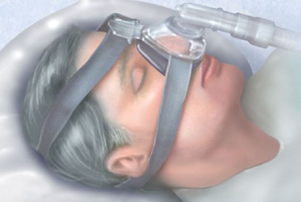 Plus de la moitié des patients se plaignent des masques de PPC lors du traitement contre l’apnée du sommeil
