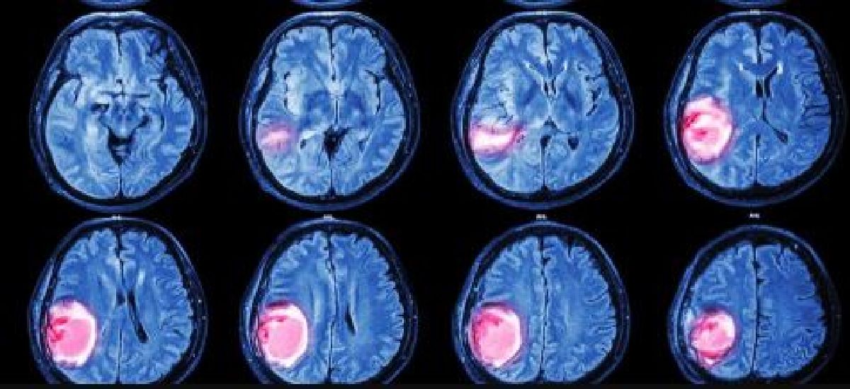 7 signes avant-coureurs d’une tumeur cérébrale que vous devez connaître