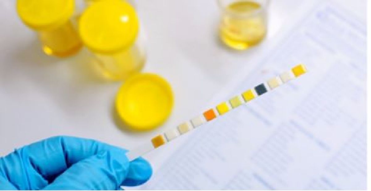 Ce que la couleur de votre urine révèle sur votre santé