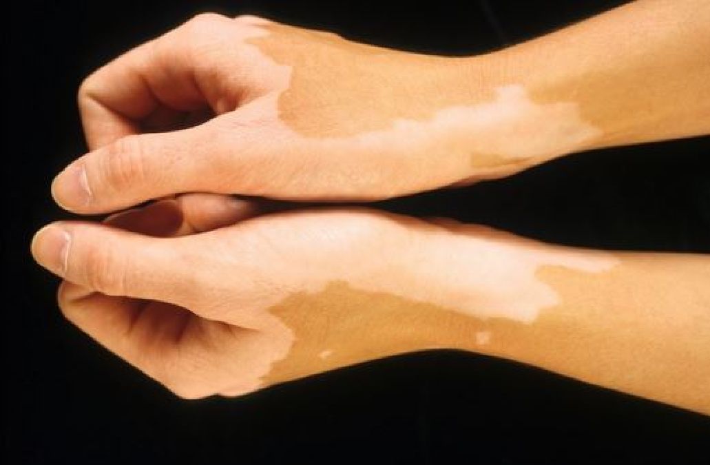 Le monde entier célèbre cette découverte des médecins Cubains  traitement du vitiligo
